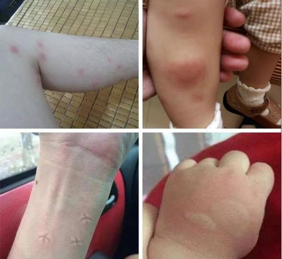 灭蚊子 孕妇_孕妇灭蚊小妙招_孕妇灭蚊