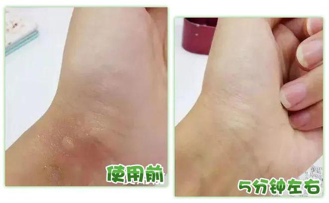 灭蚊子 孕妇_孕妇灭蚊小妙招_孕妇灭蚊