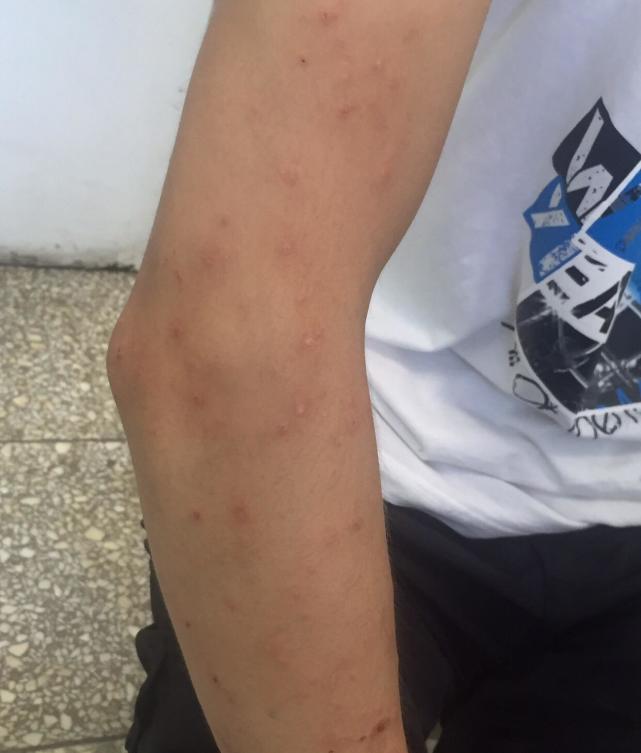 臭虫用什么药灭绝_灭杀臭虫_灭臭虫多少钱